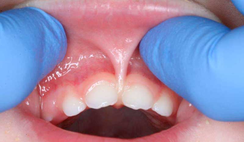 Frenillo labial en bebés: por qué casi nunca se opera